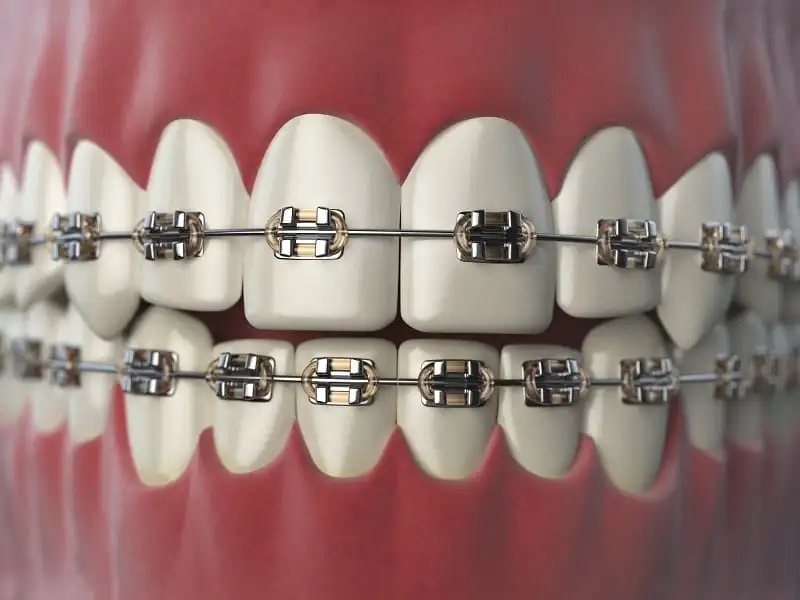 Teeth Braces